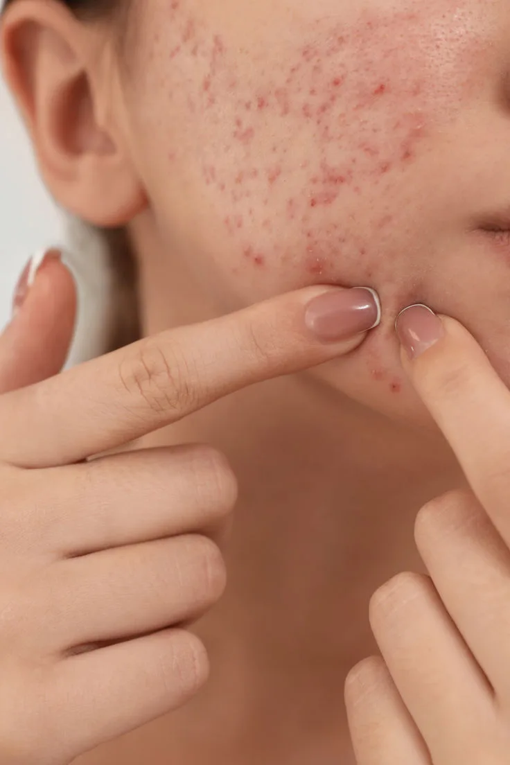 acne hormonal